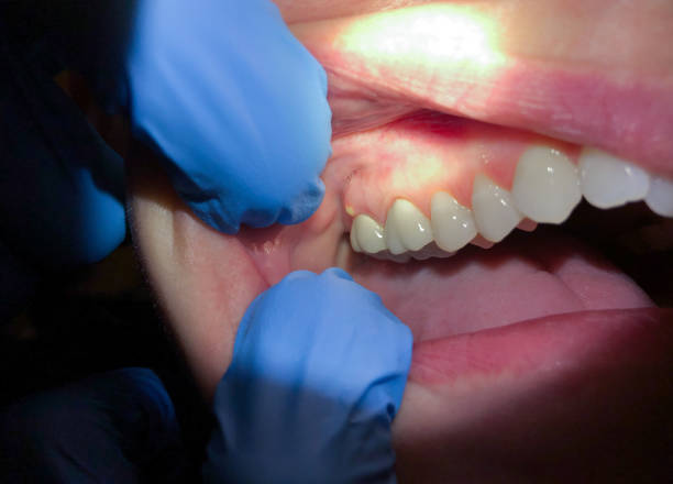 Best Emergency Dental Care for Abscessed Tooth in Hillsboro, WI